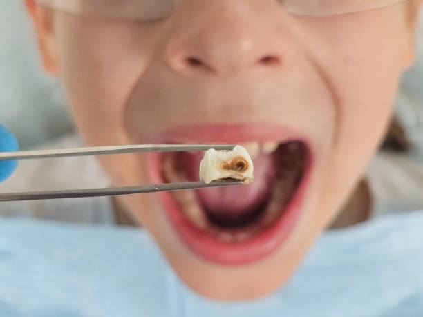 Best Chipped Tooth Repair Near Me  in Allouez, WI
